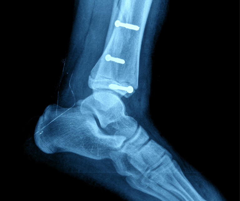 Surgical Screws: Supporting Healing and Ensuring Stability